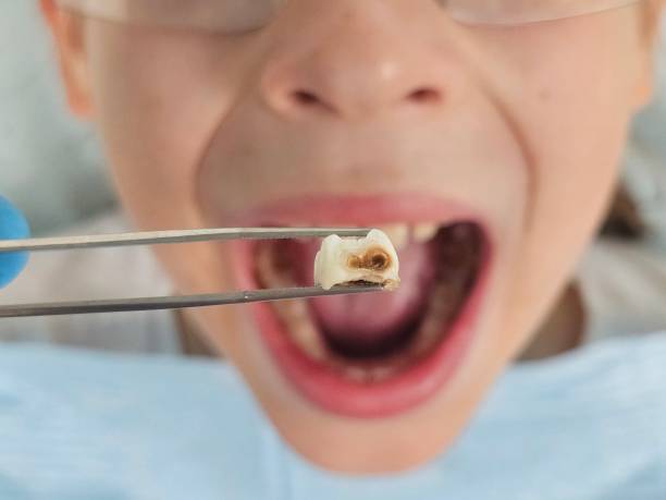 Best Emergency Wisdom Teeth Removal in Jasper, TN